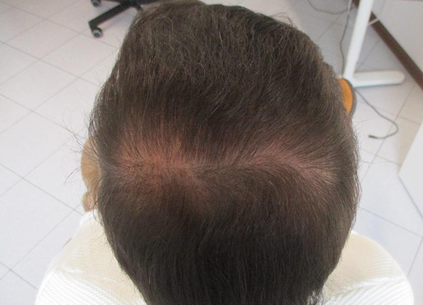 Classificazione della caduta dei capelli
